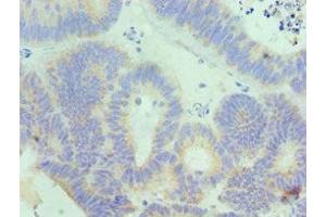 Immunohistochemistry of paraffin-embedded human colon cancer using ABIN7156833 at dilution of 1:100 (IL18RAP Antikörper  (AA 390-599))