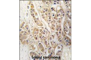 Formalin-fixed and paraffin-embedded human breast carcinoma tissue reacted with CLIC4 antibody , which was peroxidase-conjugated to the secondary antibody, followed by DAB staining. (CLIC4 Antikörper)
