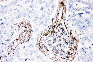 Anti-  Caveolin-1 picoband antibody, IHC(P): Human Lung Cancer Tissue