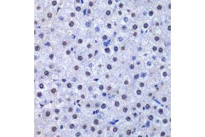 Immunohistochemistry of paraffin-embedded human liver cancer using GSTP1 antibody.