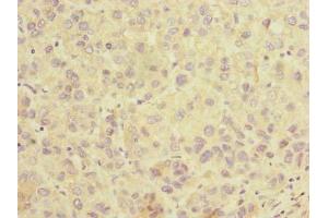 Immunohistochemistry of paraffin-embedded human liver cancer using ABIN7170191 at dilution of 1:100 (SLC25A36 Antikörper  (AA 58-110))