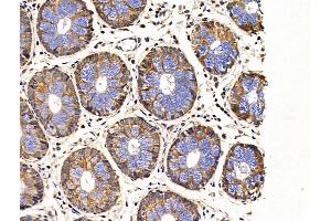 ABIN6265080 and ABIN6268997 at 1/100 staining Human colorectal cancer and adjacent normal tissues by IHC-P.