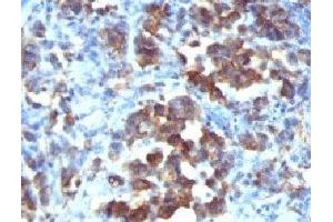 Formalin-fixed, paraffin-embedded human gastric carcinoma stained with Cdc20 antibody (CDC20/1102) (CDC20 Antikörper)