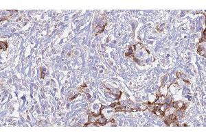 ABIN6277587 at 1/100 staining Human urothelial cancer tissue by IHC-P. (MERTK Antikörper  (Internal Region))