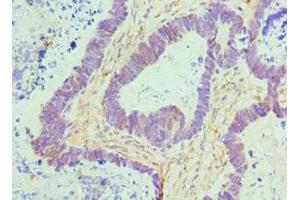 Immunohistochemistry of paraffin-embedded human ovarian cancer using ABIN7172779 at dilution of 1:100 (CTCF Antikörper  (AA 1-260))