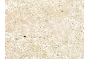 ABIN6262443 and ABIN6276778 at 1/100 staining human astrocytoma by IHC-P.