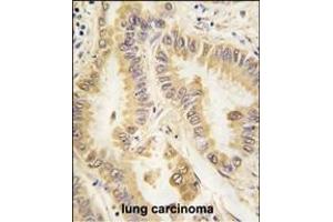 Formalin-fixed and paraffin-embedded human lung carcinoma tissue reacted with SOD2 Monoclonal Antibody (ABIN387807 and ABIN2843901) , which was peroxidase-conjugated to the secondary antibody, followed by DAB staining. (SOD2 Antikörper)