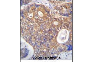 ICS Antibody (N-term) (ABIN656869 and ABIN2846073) immunohistochemistry analysis in formalin fixed and raffin embedded human colon carcinoma followed by peroxidase conjugation of the secondary antibody and DAB staining.
