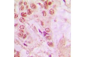 Immunohistochemical analysis of hnRNP A1 staining in human lung cancer formalin fixed paraffin embedded tissue section. (HNRNPA1 Antikörper  (Center))