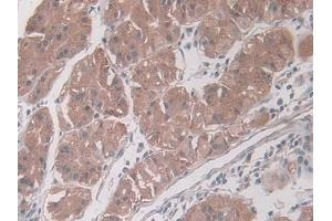 DAB staining on IHC-P; Samples: Human Glioma Tissue) (PAI1 Antikörper  (AA 25-402))
