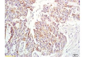 Formalin-fixed and paraffin embedded human rectal carcinoma labeled with Anti-IL-6 Polyclonal Antibody, Unconjugated (ABIN872547) at 1:200 followed by conjugation to the secondary antibody and DAB staining (IL-6 Antikörper  (AA 51-150))