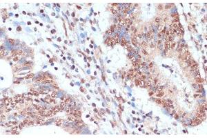 Immunohistochemistry of paraffin-embedded Human colon carcinoma using NAA20 Polyclonal Antibody at dilution of 1:100 (40x lens). (NAT5 Antikörper)