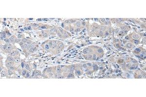 Immunohistochemistry of paraffin-embedded Human breast cancer tissue using RASSF8 Polyclonal Antibody at dilution of 1:35(x200)