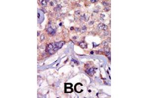 Formalin-fixed and paraffin-embedded human cancer tissue reacted with LCK polyclonal antibody  , which was peroxidase-conjugated to the secondary antibody, followed by AEC staining.