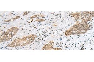 Immunohistochemistry of paraffin-embedded Human esophagus cancer tissue using CALCOCO1 Polyclonal Antibody at dilution of 1:50(x200) (CALCOCO1 Antikörper)