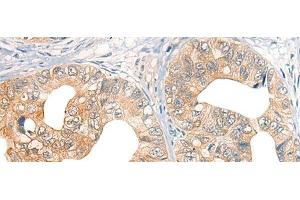 Immunohistochemistry of paraffin-embedded Human gastric cancer tissue using CORO2A Polyclonal Antibody at dilution of 1:45(x200)