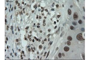 Immunohistochemical staining of paraffin-embedded Adenocarcinoma of breast using anti-IL-3 (ABIN2452543) mouse monoclonal antibody.