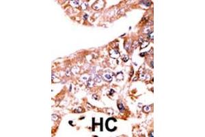 Formalin-fixed and paraffin-embedded human cancer tissue reacted with the primary antibody, which was peroxidase-conjugated to the secondary antibody, followed by AEC staining.
