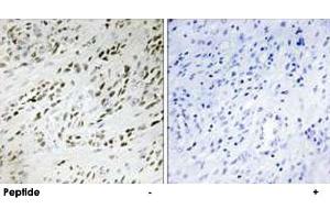 Immunohistochemistry analysis of paraffin-embedded human prostate carcinoma tissue, using TSHZ2 polyclonal antibody . (TSHZ2 Antikörper)