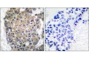 Immunohistochemistry analysis of paraffin-embedded human breast carcinoma tissue, using Keratin 17 Antibody. (KRT17 Antikörper  (AA 381-430))