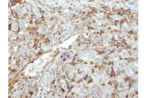 IHC-P Image Immunohistochemical analysis of paraffin-embedded CL1-0 xenograft, using GK5, antibody at 1:500 dilution. (GK5 Antikörper  (Center))