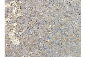 ABIN6260513 and ABIN6269192 at 1/100 staining human melanoma by IHC-P.