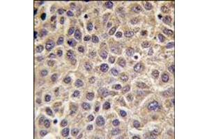 Formalin-fixed and paraffin-embedded human hepatocarcinoma tissue reacted with MTMR8 antibody (C-term), which was peroxidase-conjugated to the secondary antibody, followed by DAB staining. (MTMR8 Antikörper  (C-Term))