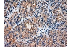 Immunohistochemical staining of paraffin-embedded Carcinoma of kidney using anti-AMY2A (ABIN2452539) mouse monoclonal antibody. (AMY2A Antikörper  (AA 300-511))