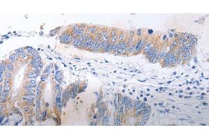 Immunohistochemistry of paraffin-embedded Human colon cancer tissue using SERP1 Polyclonal Antibody at dilution 1:30 (SERP1 Antikörper)