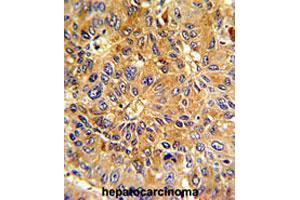 Formalin-fixed and paraffin-embedded human hepatocarcinomareacted with CCNA2 polyclonal antibody , which was peroxidase-conjugated to the secondary antibody, followed by AEC staining. (Cyclin A Antikörper  (N-Term))
