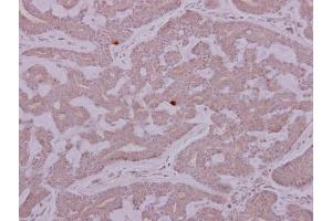 IHC-P Image PCYT2 antibody detects PCYT2 protein at cytoplasm on human breast cancer by immunohistochemical analysis. (PCYT2 Antikörper)
