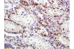Formalin-fixed and paraffin embedded human colon carcinoma labeled with Anti-CEAcam8 Polyclonal Antibody, Unconjugated (ABIN672651) at 1:200 followed by conjugation to the secondary antibody and DAB staining (CEACAM8 Antikörper  (AA 51-150))