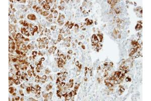 IHC-P Image Immunohistochemical analysis of paraffin-embedded CL1-5 xenograft, using Importin 13, antibody at 1:100 dilution. (IPO13 Antikörper  (C-Term))
