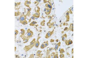 Immunohistochemistry of paraffin-embedded human liver cancer using BTD antibody (ABIN5973709) at dilution of 1/100 (40x lens). (BTD Antikörper)