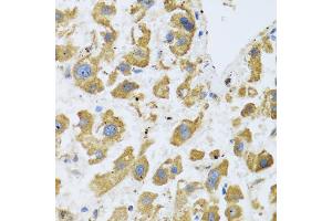 Immunohistochemistry of paraffin-embedded human liver cancer using BTD antibody (ABIN5973709) at dilution of 1/100 (40x lens).