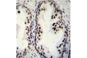 Formalin fixed and paraffin embedded human prsotate carcinoma stained with DDX27 Antibody (C-term) Cat. (DDX27 Antikörper  (C-Term))