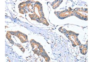 The image on the left is immunohistochemistry of paraffin-embedded Human colon cancer tissue using ABIN7130296(MTMR7 Antibody) at dilution 1/40, on the right is treated with fusion protein. (MTMR7 Antikörper)