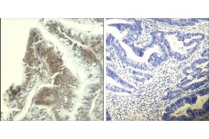 Immunohistochemical analysis of paraffin-embedded human colon carcinoma tissue using CDK6 (Ab-13) Antibody (E021542). (CDK6 Antikörper)