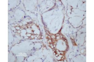 ABIN6266591 at 1/200 staining human Oral squamous cell carcinoma sections by IHC-P. (MMP14 Antikörper  (C-Term))