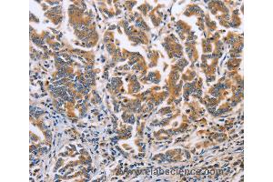 Immunohistochemistry of Human liver cancer using DOK4 Polyclonal Antibody at dilution of 1:60 (DOK4 Antikörper)