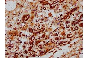 IHC image of ABIN7150368 diluted at 1:1000 and staining in paraffin-embedded human breast cancer performed on a Leica BondTM system.