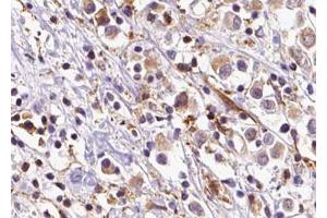 ABIN6273603 at 1/100 staining Human breast cancer tissue by IHC-P. (SLC35C2 Antikörper  (C-Term))