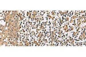 Immunohistochemistry of paraffin-embedded Human tonsil tissue using DCAF12 Polyclonal Antibody at dilution of 1:65(x200) (DCAF12 Antikörper)