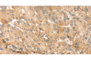 Immunohistochemistry of paraffin-embedded Human liver cancer using EVA1A Polyclonal Antibody at dilution of 1:30 (TMEM166 Antikörper)