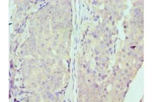 Immunohistochemistry of paraffin-embedded human colon cancer using ABIN7150341 at dilution of 1:100 (MCM7 Antikörper  (AA 360-719))