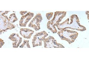 Immunohistochemistry of paraffin-embedded Human thyroid cancer tissue using ABCD1 Polyclonal Antibody at dilution of 1:80(x200) (ABCD1 Antikörper)