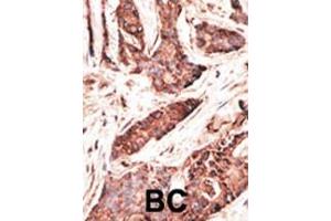 Formalin-fixed and paraffin-embedded human cancer tissue reacted with the primary antibody, which was peroxidase-conjugated to the secondary antibody, followed by AEC staining. (OASL Antikörper  (C-Term))