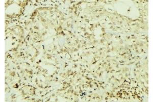 ABIN6267064 at 1/100 staining Human breast cancer tissue by IHC-P. (AKT 1/2/3 Antikörper  (pTyr312, pTyr315, pTyr316))