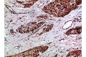 Immunohistochemical analysis of paraffin-embedded human-cervical-cancer, antibody was diluted at 1:200 (Thymopoietin Antikörper  (AA 1-50))