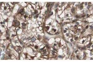 Affinity Purified anti-MAD2L2 antibody shows strong nuclear and cytoplasmic staining of tumor cells in cancerous human kidney tissue. (MAD2L2 Antikörper  (AA 3-14))